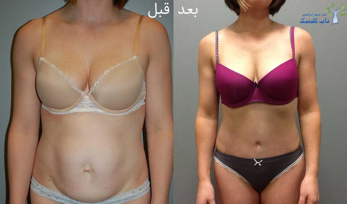 قبل-و-بعد-از-عمل-جراحی-زیبایی-ابدومینوپلاستی