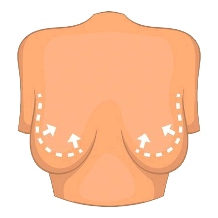 ماموپلاستی-یا-جراحی-کوچک-کردن-سینه
