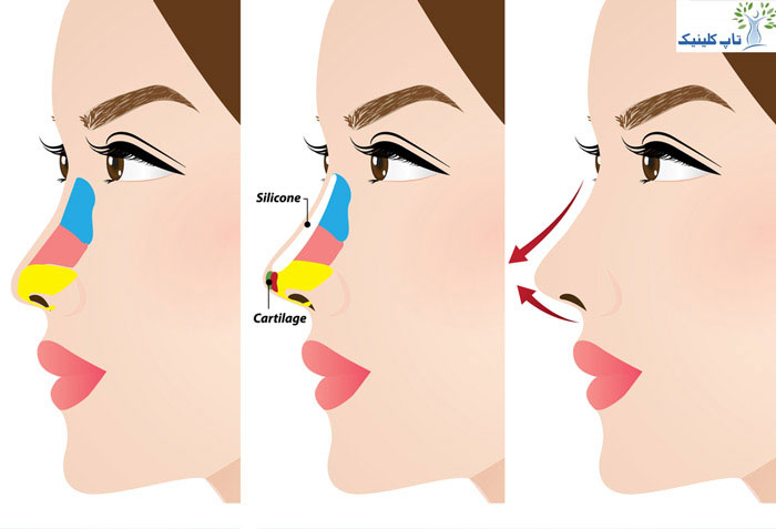 نکات مهم و اقدامات بعد از جراحی زیبایی بینی