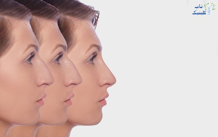 اهمیت شکل صورت در جراحی بینی