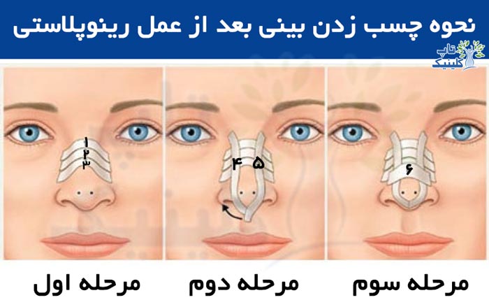 آموزش نحوه چسب زدن بینی بعد از عمل رینوپلاستی