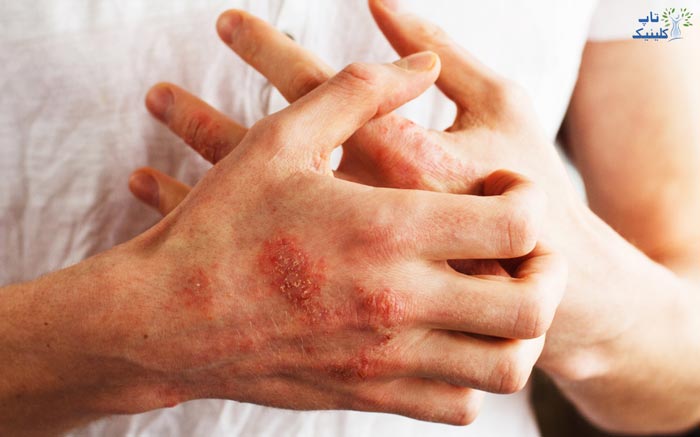 علل ایجاد لکه های خشکی پوست