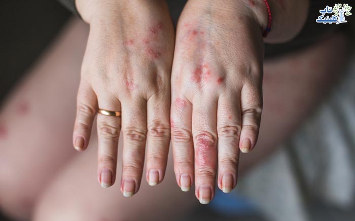 علل ایجاد لکه های خشکی پوست