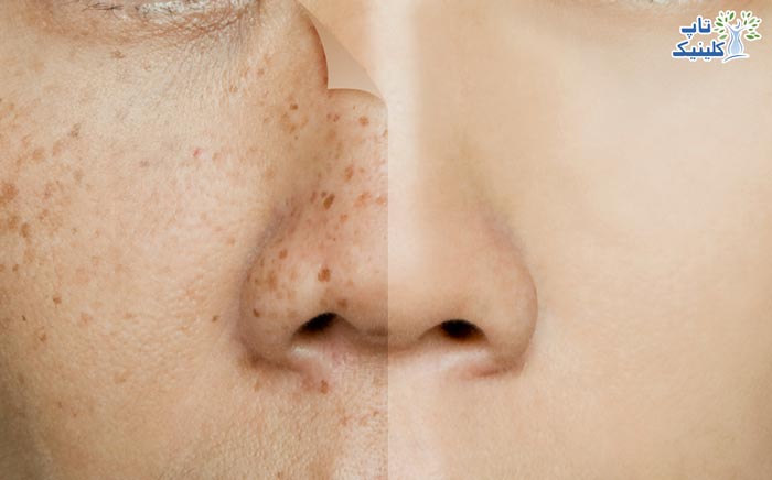 روش های شفاف سازی پوست صورت