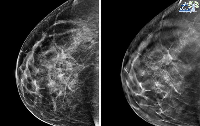 آیا ماموگرافی به پروتز سینه آسیب وارد می کند؟